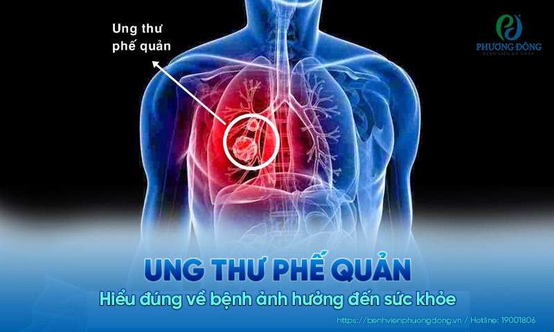 HÌNH ẢNH MINH HỌA UNG THƯ PHẾ QUẢN GIAI ĐOẠN CUỐI VỚI TỔN THƯƠNG NẶNG