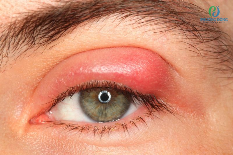Viêm đau mờ bị - mắt bị đau ngứa khó chịu làm giảm khả năng nhìn