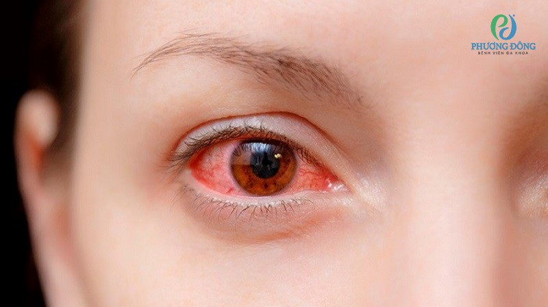 Sưng mắt là triệu chứng của viêm kết mạc