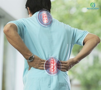 Vôi hóa cột sống: Triệu chứng, nguyên nhân, biến chứng và cách điều trị 