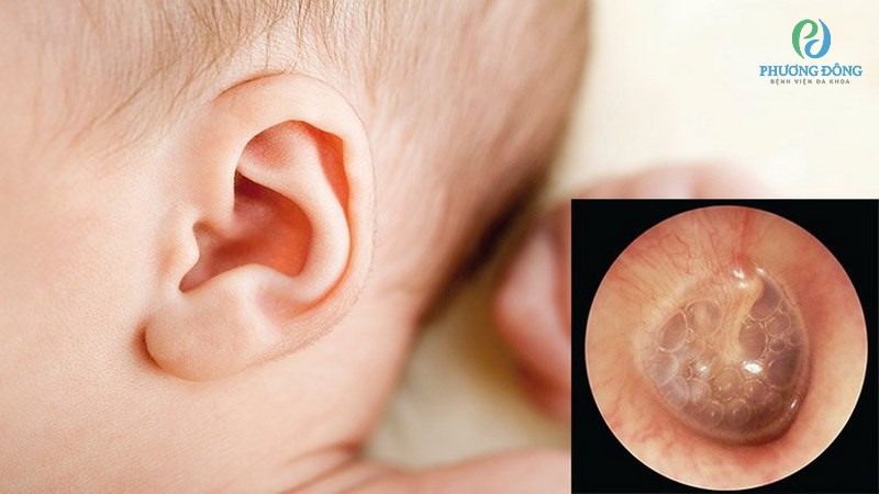 Nhiễm trùng tai xảy ra khi ứ đọng dịch ở trong tai giữa