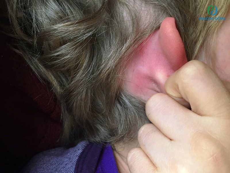 Nhiễm trùng tai không được điều trị có thể gây nên viêm xương chũm