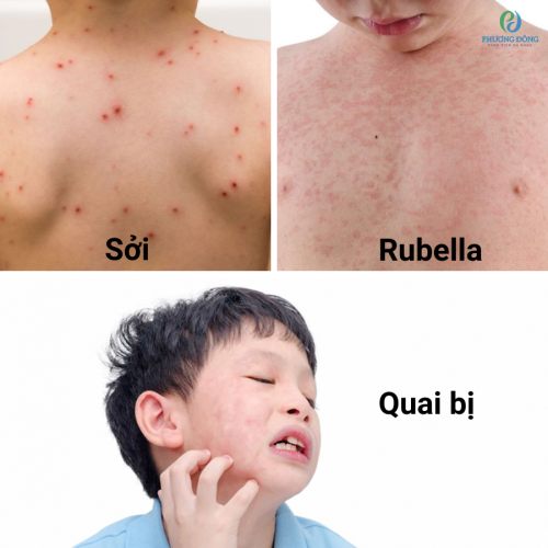 Sởi, quai bị và rubella: Bệnh truyền nhiễm đã có vacxin phòng ngừa