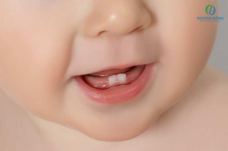 Bé mọc răng cũng là nguyên nhân gián tiếp dẫn đến đi ngoài nhiều lần do tiêu chảy