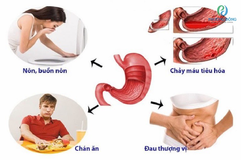 Các triệu chứng thường gặp khi bị viêm hang vị dạ dày