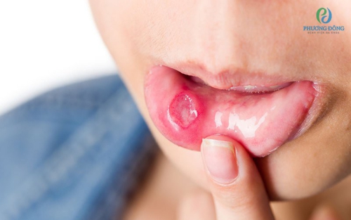 Bệnh viêm loét miệng và những điều cần biết