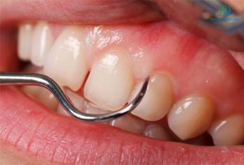 Tổng quan về viêm nướu răng và cách điều trị nhanh chóng