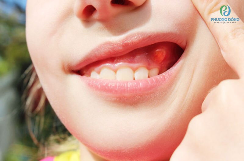 Viêm nướu răng là tình trạng nướu/lợi bị tổn thương do vi khuẩn gây nên