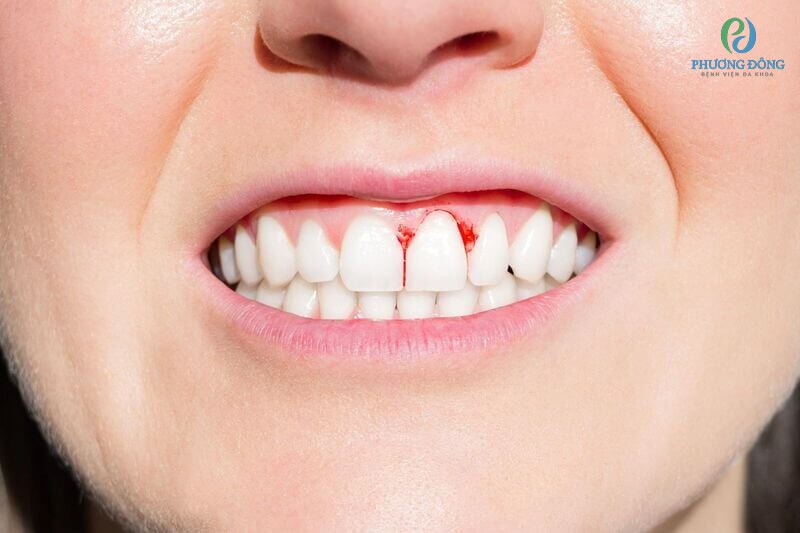 Hình ảnh viêm nướu răng gây chảy máu