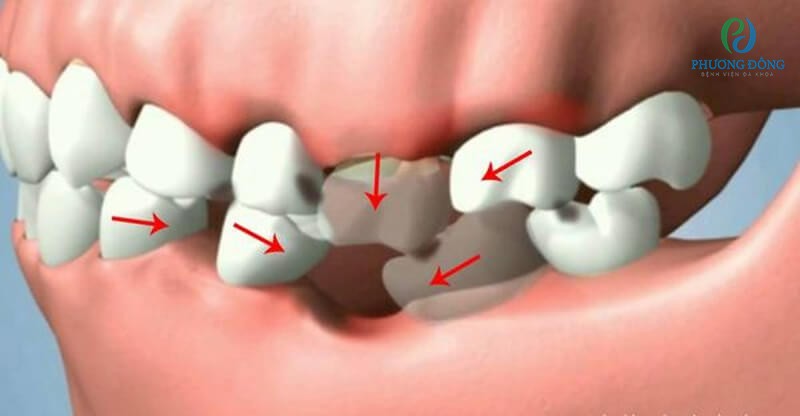 Viêm nướu răng giai đoạn nặng có thể gây mất răng khiến răng bị xô lệch