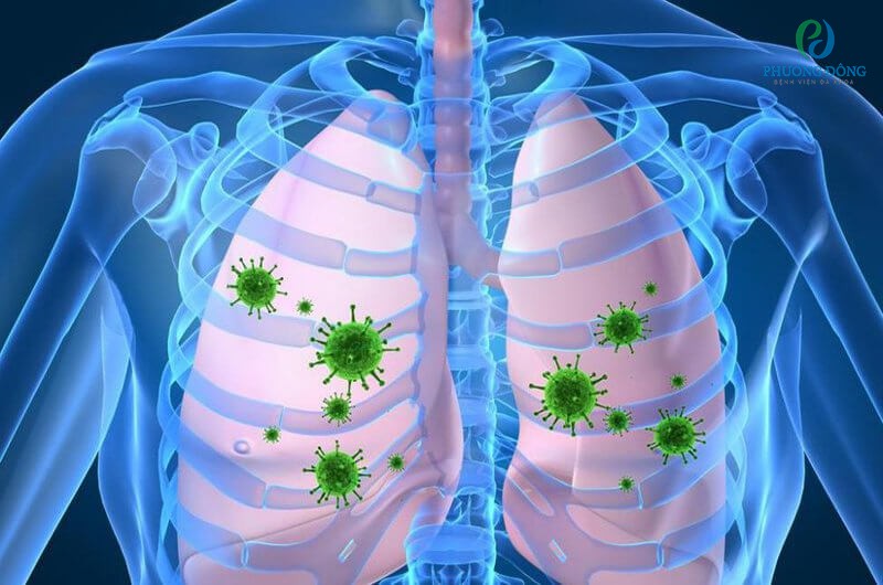Viêm phổi là biến chứng nặng do viêm lợi kéo dài mà không được điều trị