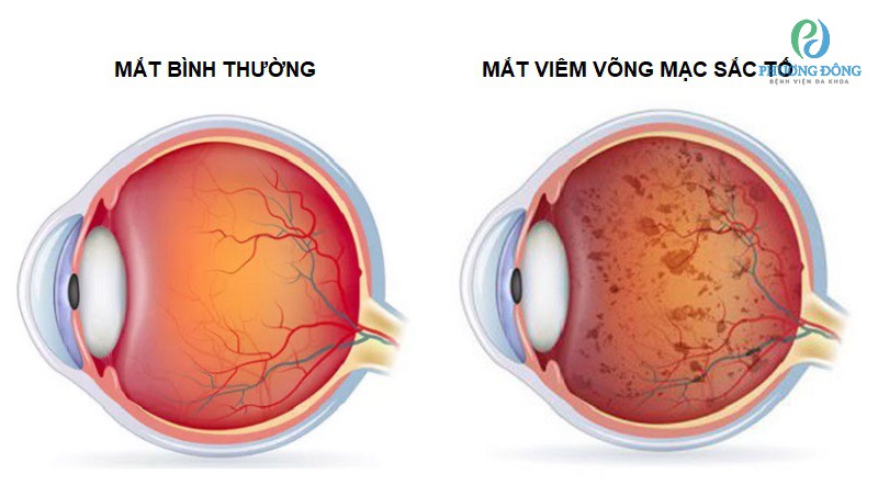 Sự khác biệt giữa mắt không viêm và mắt bị viêm