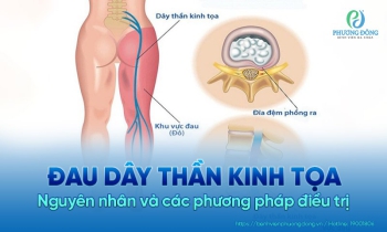 Đau dây thần kinh tọa: Nguyên nhân, triệu chứng và cách điều trị