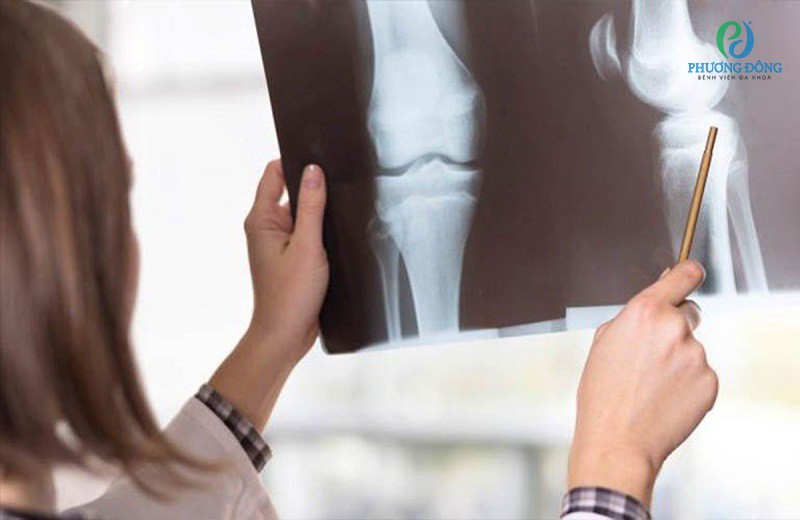 Phương pháp chụp X-quang giúp chẩn đoán tình trạng đứt dây chằng chính xác hơn