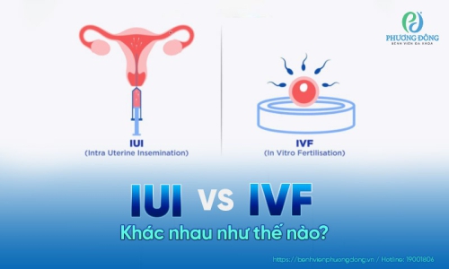 IUI và IVF khác nhau như thế nào? Nên chọn phương pháp nào?