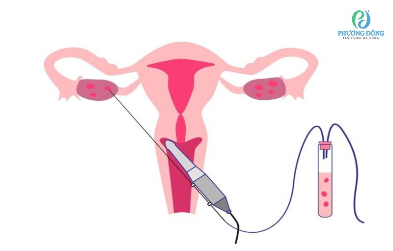 Quá trình chọc hút trứng trong IVF