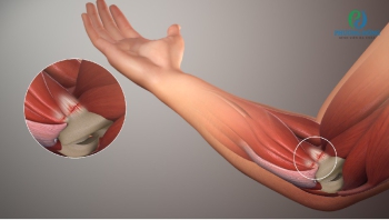 Viêm lồi cầu ngoài xương cánh tay là gì? Phương pháp điều trị bệnh 