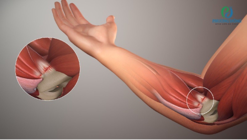 Viêm lồi cầu ngoài xương cánh tay là gì? Phương pháp điều trị bệnh 
