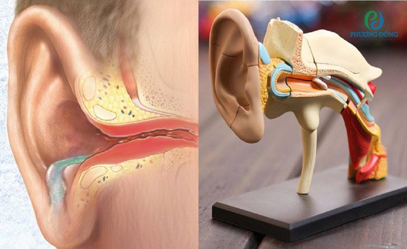 Minh họa hình ảnh viêm tai giữa chuyển dần sang mãn tính