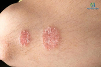 Nấm da đùi: Nguyên nhân, triệu chứng và cách điều trị