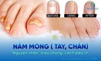 Nấm móng và cách phòng ngừa, điều trị