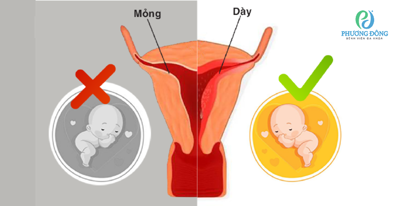 Niêm mạc dày hay mỏng đều ảnh hưởng tới khả năng thụ thai