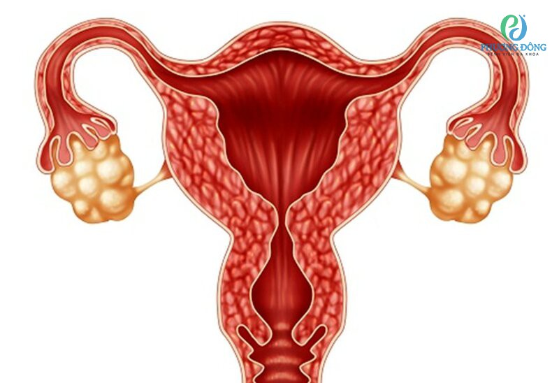 Nội mạc tử cung dày 18mm do bị hội chứng đa nang buồng trứng