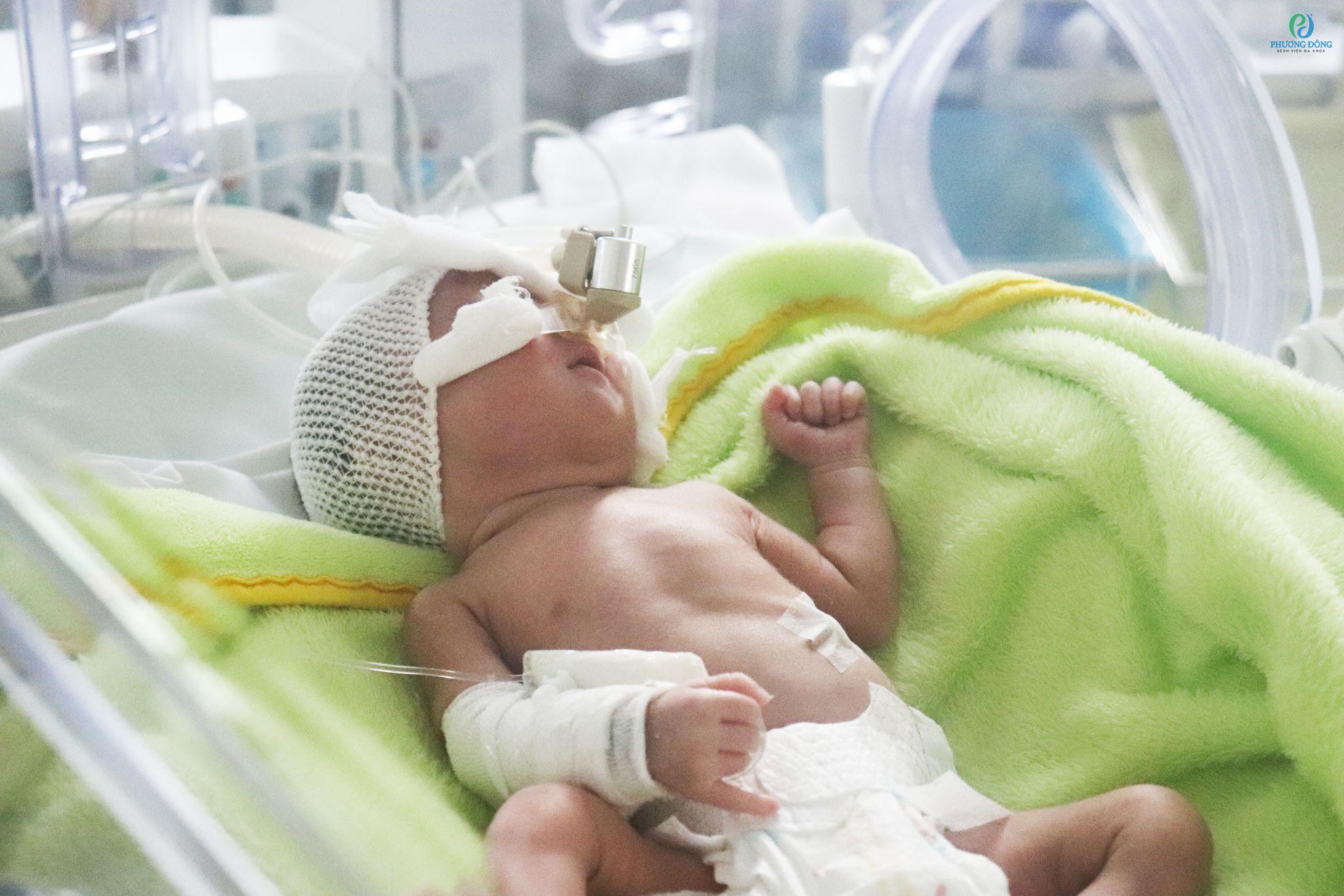 Em bé sau khi sinh non có thể gặp phải biến chứng ngắn hạn hoặc lâu hạn