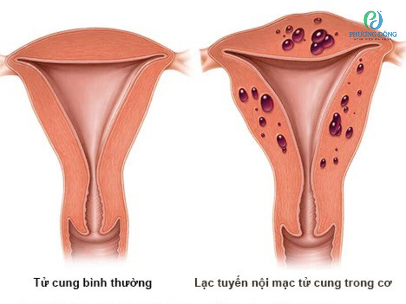 Lạc nội mạc tử cung cần nhận tư vấn thụ tinh trong ống nghiệm