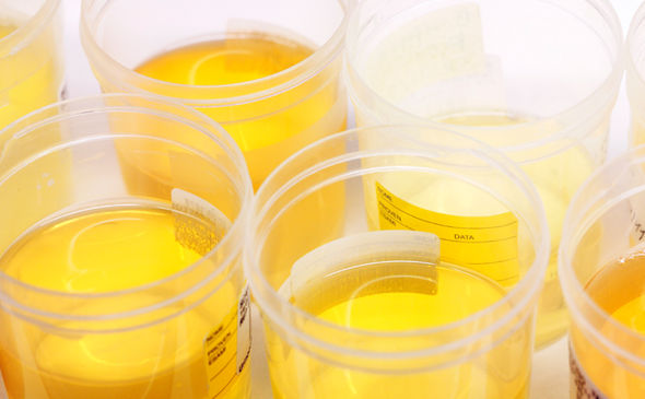 Lẫn nước tiểu là nguyên nhân khiến tinh dịch chuyển từ màu trắng sang màu vàng.