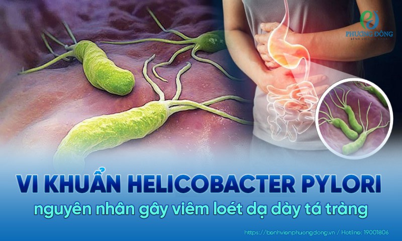 Vi khuẩn Helicobacter pylori – nguyên nhân thường gặp gây viêm loét dạ dày tá tràng