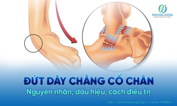 Đứt dây chằng cổ chân: Nguyên nhân, dấu hiệu và cách điều trị hiệu quả
