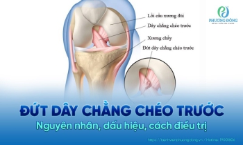 Đứt dây chằng chéo trước: Nguyên nhân, chẩn đoán và phương pháp điều trị