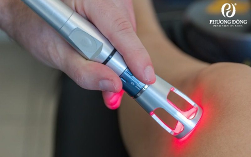 Ứng dụng laser công suất cao trong trị liệu 