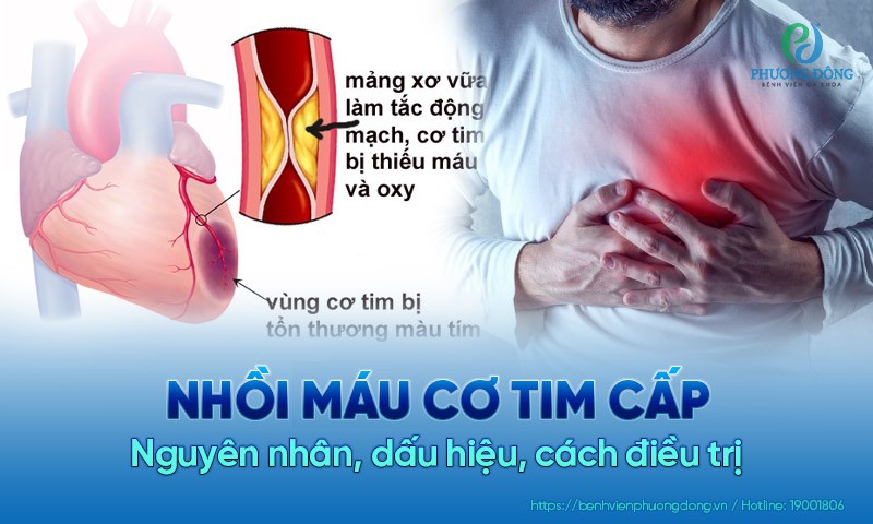 nhồi máu cơ tim cấp làm tăng nguy cơ tử vong