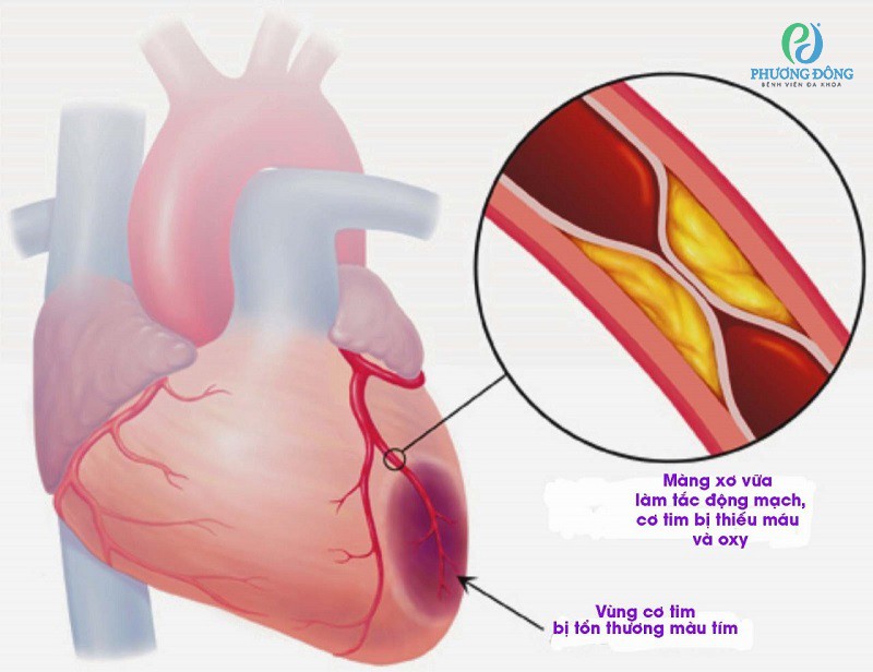 Tổn thương cơ tim gây triệu chứng nhồi máu cơ tim cấp