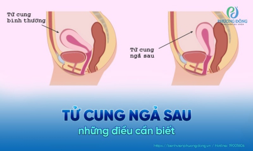 Tử cung ngả sau và những điều chị em cần biết
