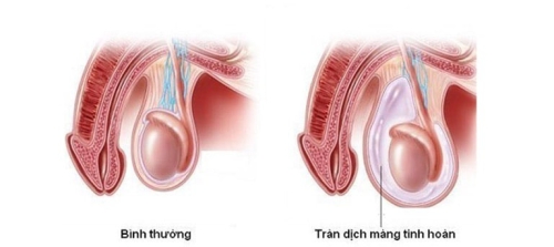 Tràn dịch màng tinh hoàn ở trẻ em và người lớn nguy hiểm không?