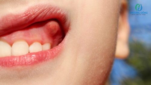 Bị áp xe răng nguy hiểm như thế nào? Và cần phải làm gì?