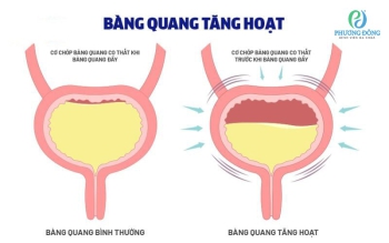 Bàng quang tăng hoạt: Nguyên nhân, triệu chứng và cách điều trị