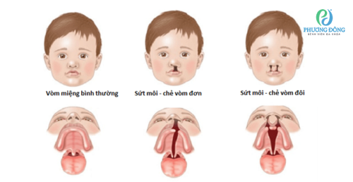 Hở hàm ếch ở trẻ: Nguyên nhân và thời điểm nên thực hiện phẫu thuật