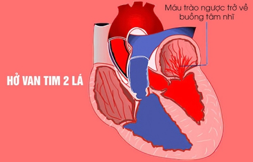 Hở van tim: Nguyên nhân, triệu chứng và cách điều trị