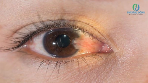Mộng mắt (mộng thịt): Nguyên nhân, dấu hiệu và cách điều trị