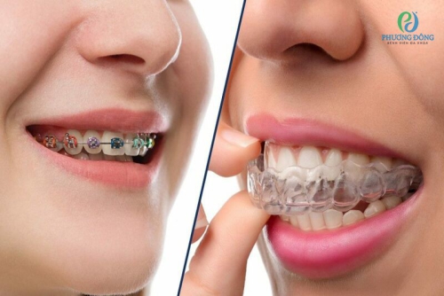 Niềng răng là gì? Những điều cần phải biết trước khi niềng răng