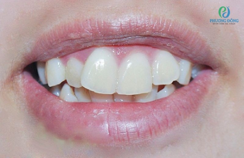 Răng hô là gì? Cách nhận biết và điều trị răng hô hiệu quả