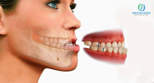Răng móm là gì? Các cách khắc phục răng móm hiệu quả 
