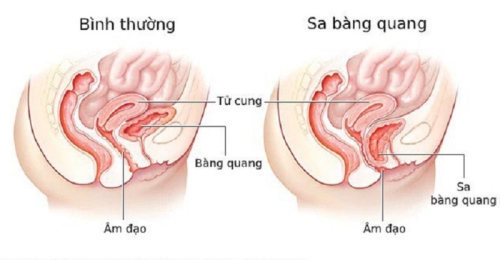 Sa bàng quang ở nữ: Nguyên nhân và cách điều trị hiệu quả