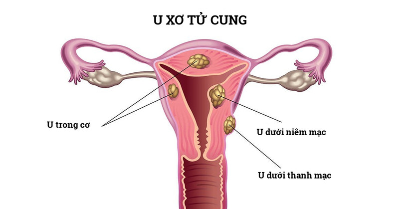 Nhân xơ tử cung dưới niêm mạc: Nguyên nhân, triệu chứng và giải pháp điều trị hiệu quả