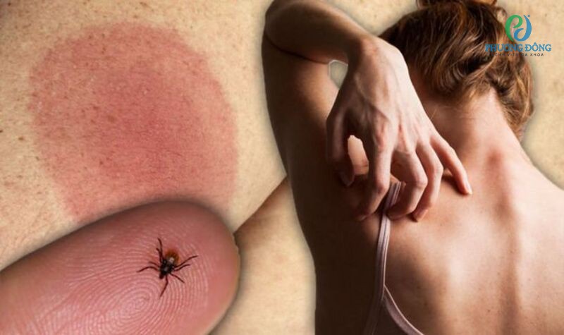  biến chứng nguy hiểm do bệnh Lyme gây ra