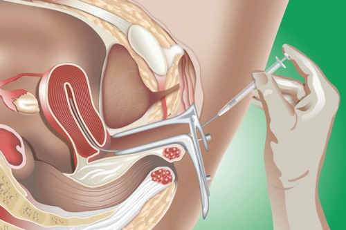 Bơm IUI lần 2 thất bại có nên làm tiếp không? 